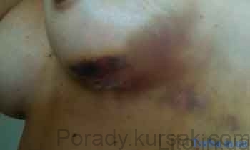 mammoplastyka (4)
