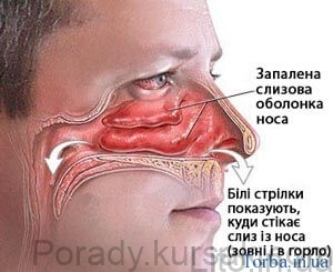 sopli
