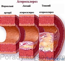 атеросклероз